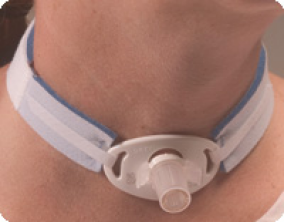 Tracheostomy image