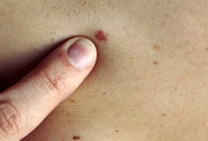 skin cancer image