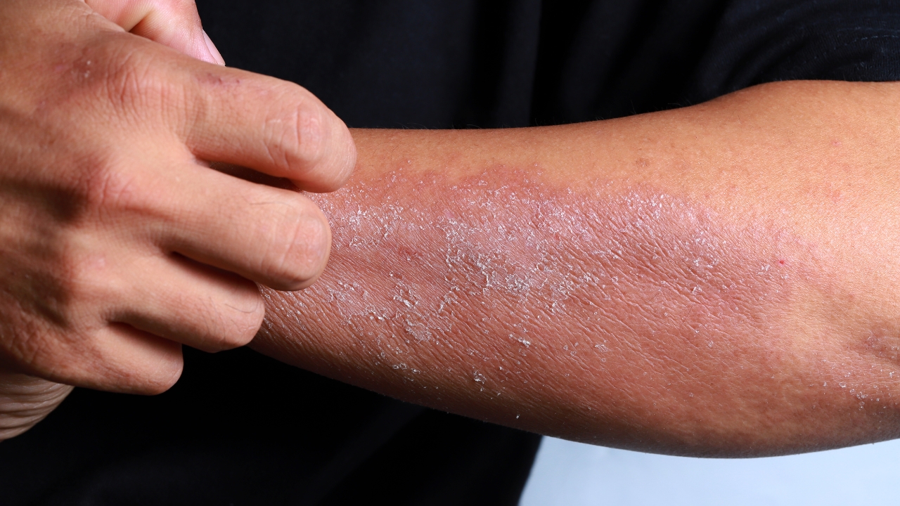 skin cancer vaccine