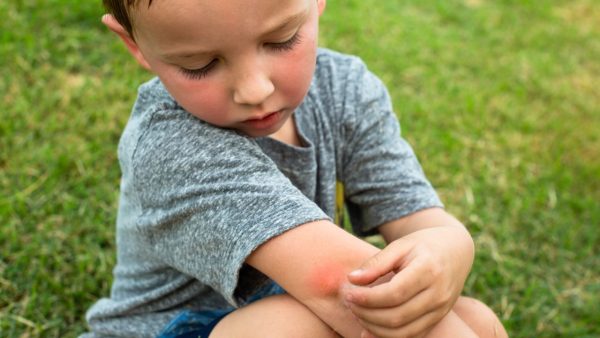 nhs bites and stings
